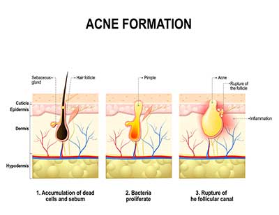 Acne Formation